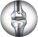 Outpatient Robotic Total Knee Replacement service
