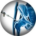 Hip Arthroscopy service