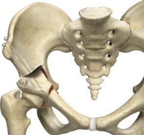 Hip Preservation Surgery