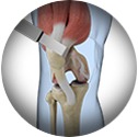 ubvastus Muscle-sparing Knee Replacement
