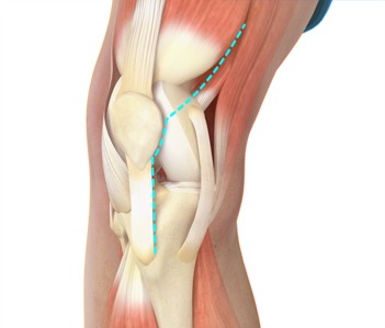 Subvastus Muscle-sparing Knee Replacement